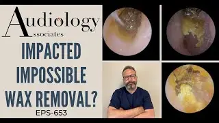 IMPACTED IMPOSSIBLE EAR WAX REMOVAL? - EP653