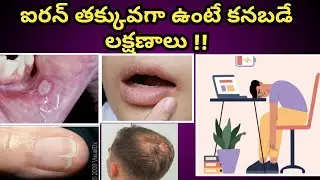 Iron Deficiency symptoms in Telugu| ఐరన్ తక్కువగా ఉంటే కనబడే లక్షణాలు.