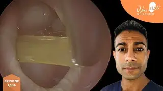 1,184 - Microsuction of Mucoid Discharge from Potentially Dangerous Middle Ear Infection