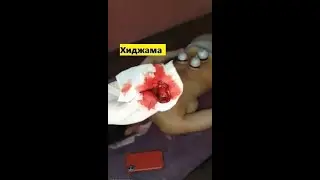 💮Хиджама, делать или нет?⛑