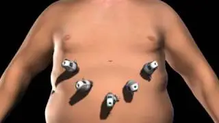 Houston Sleeve Gastrectomy Surgery - Texas Laparoscopic Consultants