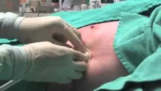 Chest Tube Insertion NEJM