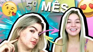 MANCHAS SUMINDO 😍 QUARTO E QUINTO MÊS DO ROACUTAN