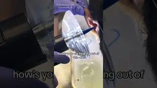 Appointment was for foreign body removal..