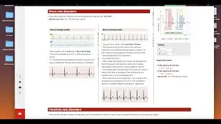 ECG of heart rate disorders