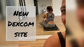 An alternative Dexcom placement 