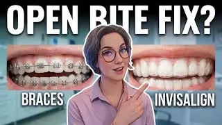 Invisalign for Open Bite