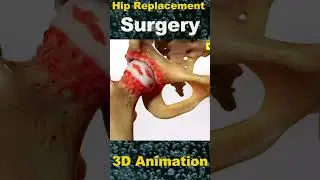 Total Hip Replacement Surgery: Restoring Mobility and Quality of Life