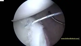 Posterior Shoulder Dislocation and SLAP lesion Surgery. 12 13 18  JK