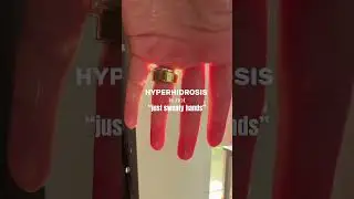 Hyperhidrosis is NOT “just sweaty hands” To learn more connect with us on Instagram! 💙