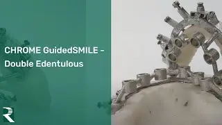 CHROME GuidedSMILE - Double Edentulous Surgery