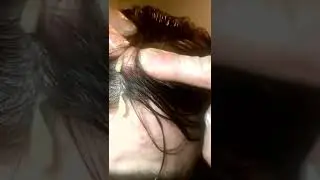 Black head removal on face - Blackheads on back treatment