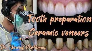 Tooth preparation. Ceramic veneers. Dr. Yousef Alothman.