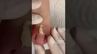 unhas encrvadas