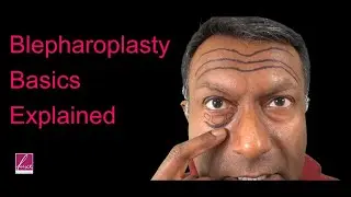 Blepharoplasty Basics--what causes the eyelid problems and why blepharoplasty works so well