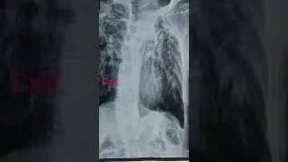 comment the finding in this chest xray. 