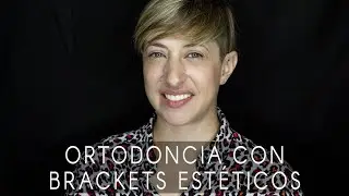 La sonrisa de Isabel: ortodoncia con brackets estéticos
