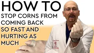 How To Treat Corns WIth Gel Rings