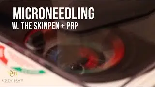 Microneedling w. the SkinPen + PRP | Scottsdale, AZ