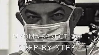 Hos to do it? Hysteroscopic myoma resection by Osama Shawki