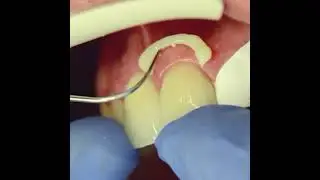 3M™  RelyX Universal. Excess Cleanup Video