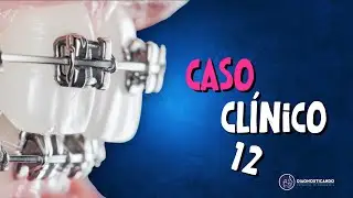 Caso Clínico 12-  Características de Classe III, mas...