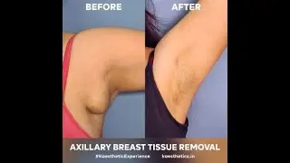 Removal of Axillary Breast Tissue 