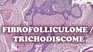 LE FIBROFOLLICULOME / TRICHODISCOME - PATHOLOGIE