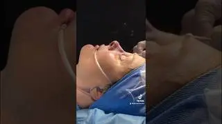 Amazing Rhinoplasty Transformation! #shorts #rhinoplasty