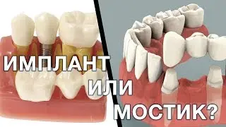 Имплант или зубной мостик. Что лучше выбрать? Имплантация зубов. Мост зубной.