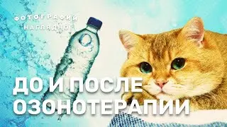 До и После Озонотерапии. Фотографии наглядно.