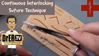 continuous interlocking suturing technique
