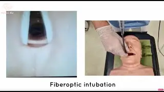 Fiberoptic intubation