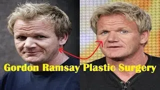 Gordon Ramsay Plastic Surgery Before and After