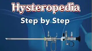 Step by step hysteroscopic myoma resection by Osama Shawki