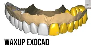 Wax up exocad разбор кейса. Exocad modelling