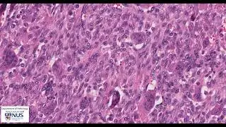 Bone: Giant cell tumour - Talking slide