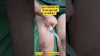 Main Reason for Knee Swelling After Ligament Tear🔥🔥