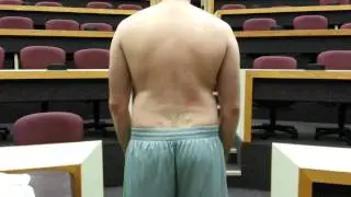 Adam's Forward Bend Test Demonstration