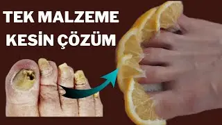 2 DOĞAL ÇÖZÜM- TEK MALZEMELİ TIRNAK MANTARI TEDAVİSİ/ EVDE NASIL YAPILIR?