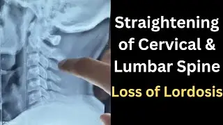 Straightening of Cervical Curvature, Loss Of Lumbar lordosis, Lumbar curvature Straightening in Xray