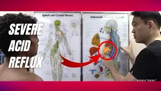 SEVERE Acid Reflux and Sinus Headache HELPED by Dr Suh