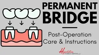 What To Do After Getting a Permanent Dental Bridge | #experienceHFD