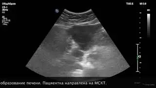 УЗИ печени.  Объемное образование.