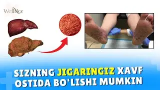 ЖИГАР ЦИРРОЗИ ВА ГЕПАТИТ КАСАЛЛИГИ ДАВОСИ