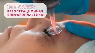 Non-surgical laser blepharoplasty of the eyelids