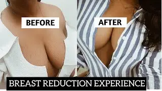 MY BREAST REDUCTION EXPERIENCE: HOW MUCH IT REALLY COST+MY REAL BRA SIZE & DID I REGRET IT?
