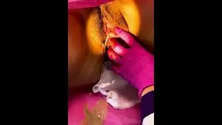 Bartolinitis!! Mucho dolor 🤕 Observa cómo se drena y el líquido con pus.