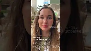 История пациентки: ринопластика и её результаты @globalmedikTV #ринопластика #ринопластикатурция