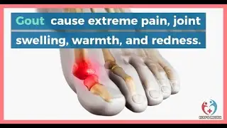 Gout - causes, symptoms, diagnosis, treatment, pathology
